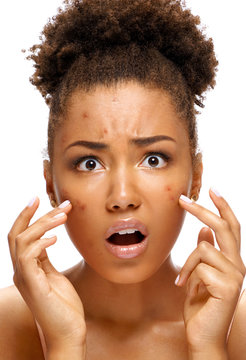 Ugly Teen Girl In Shock Of Her Acne. Photo Of African American Girl With Problem Skin On White Background. Skin Care Concept