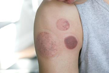 Fototapeta premium Athlete Man Cupping after Injury to Increase Blood Circulation and Speed Up Healing