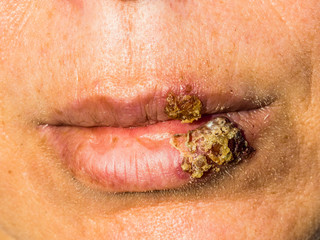 Herpes labial