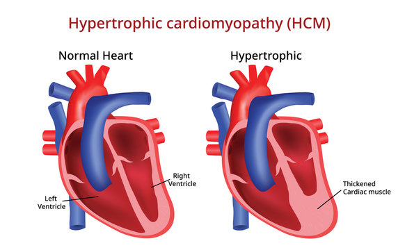Hypertrophic cardiomyopathy, Heart disease