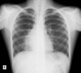 X-ray of the lungs. Bronchopneumonia child. 