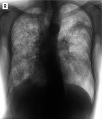 X-ray of the lungs. Fibrous-cavernous tuberculosis. Negative.