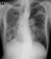 X-ray of the lungs. Fibrous-cavernous tuberculosis. 