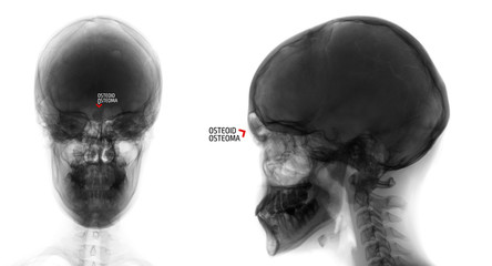 X-ray of the skull. Osteoid-osteoma of the frontal sinus. Negative. Marker.