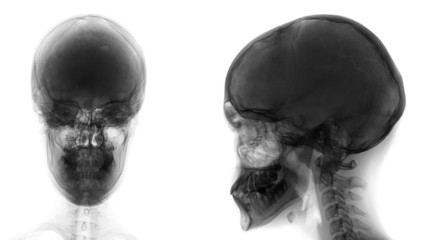 X-ray of the skull. Osteoid-osteoma of the frontal sinus. Negative. 