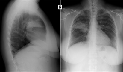 X-ray of the lungs. Pneumonia of the S2 segment lung right. 