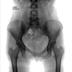 X-ray of the pelvis and the lumbosacral spine. Spina bifida S1. Negative. Marker.