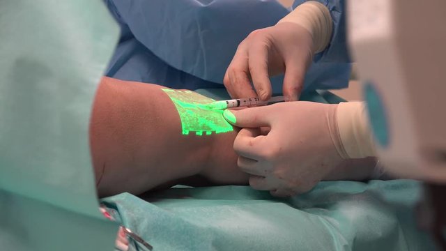Sclerotherapy is one method for the treatment of spider veins, occasionally varicose veins, and venous malformations.V aricose, Sclerotherapy and Vein Viewer