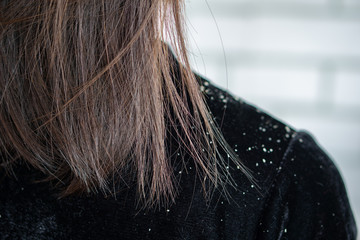  woman hair having problem with dandruff on shoulder  - obrazy, fototapety, plakaty