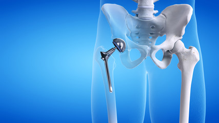 3d rendered medically accurate illustration of a hip replacement