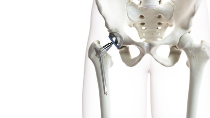 3d rendered medically accurate illustration of a hip replacement - obrazy, fototapety, plakaty