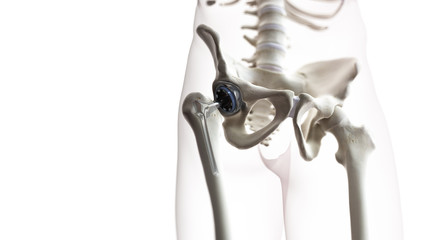 3d rendered medically accurate illustration of a hip replacement - obrazy, fototapety, plakaty