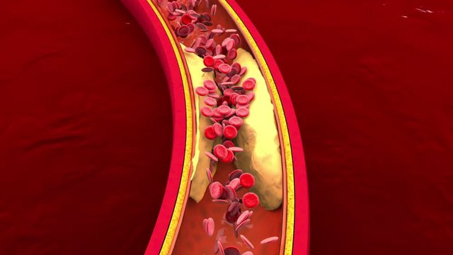 3D rendered Animation of Hemoglobin cells flowing through a clogged Artery developing the illness Arteriosclerosis.
