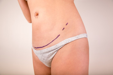 Woman belly marked out for cosmetic surgery. Isolated on white.