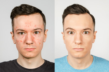 two guys before-after: left guy with acne, red spots, problem skin, right guy with healthy skin. Acne treatment concept