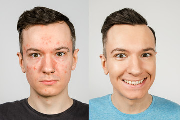 two guys before-after: left guy with acne, red spots, problem skin, right guy with healthy skin. Acne treatment concept