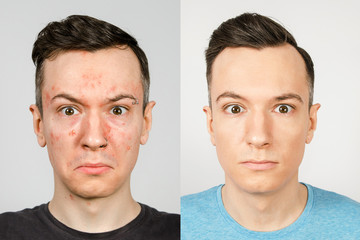 two guys before-after: left guy with acne, red spots, problem skin, right guy with healthy skin. Acne treatment concept