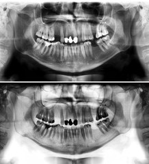 Panoramic radiograph is a scanning dental X-ray of the upper jaw maxilla and lower jawbone mandible. The photo shows a young man aged thirty seven 37 years © feelisgood