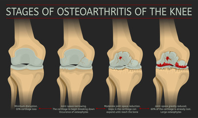 Stages of osteoarthritis of the knee