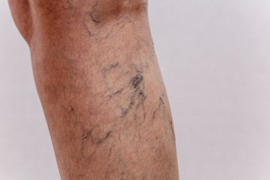 Concept for medicine and cosmetology. 60 year old woman shows in detail her legs with varicose veins and cellulite on a white isolated background.