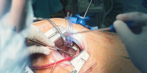 retractor and surgeon hands for open heart cardiac surgery in hospital cardiovascular microsurgery with minithoracotomy procedure, surgeon operating beating heart surgery with his medical team