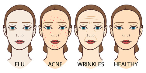 Set of woman faces: pale skin, acne, wrinkles and young healthy skin.  Dermatology, skin care