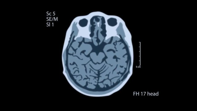 Brain MRT scan. One view on the black screen. Each video is loopable. 4k medical background