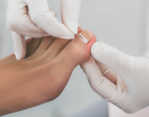 Doctor podiatry treats ingrown nail. onychocryptosis, nail disease