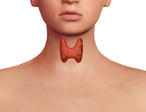 Thyroid cancer. development of cancer in the thyroid gland in the human body. 3D rendering