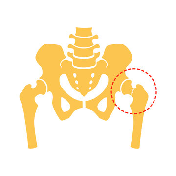 Femoral neck fracture. Fragment of the structure of the human skeleton. Pelvic girdle and thighs. Silhouette. Sign. Vector.