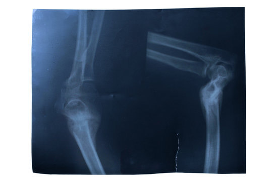 x-ray of forearm