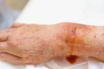 Close up old woman hand, upper limb or arm to the wounded waiting for nurse treatment on wound...