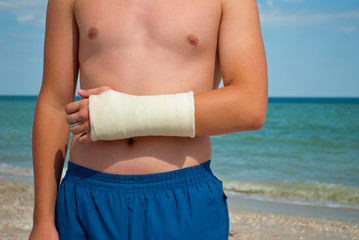 Gypsum fracture on a man's hand, sand close-up against the background of the sea and the sky...