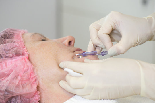 Close-up of procedure for face lifting PDO Suture operation, face lifting surgery. innovative technique of New thread lift, NovaThreads and Silhouette InstaLift