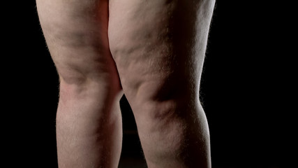 Fototapeta na wymiar Cellulite male legs with stretch marks, hormonal disorder, skin care, diet