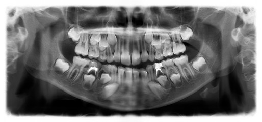 Panoramic radiograph is a scanning dental X-ray of the upper jaw maxilla and lower jawbone mandible. The photo shows a child aged 7 seven years - 245210279