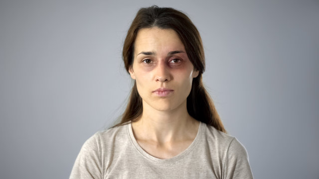 Portrait Of Bruised Woman Looking At Camera, Domestic Violence Victim, Awareness