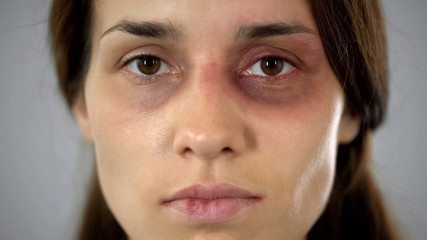 Woman with bruise on face sadly looking at camera, victim of assault in family