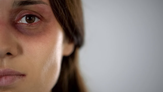 Sad lady with bruised face looking at camera, violence, gender discrimination