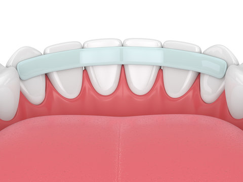 3d render of  teeth with dental reinforcement fiber