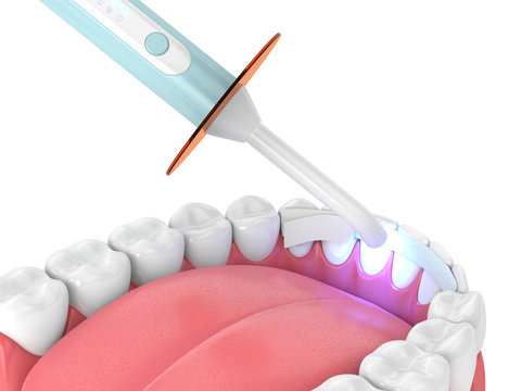 3d render of jaw with dental polymerization lamp and dental fiber