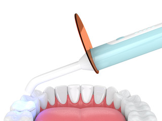 3d render of jaw with dental polymerization lamp and light cured onlay