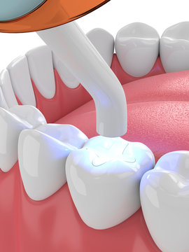 3d render of jaw with dental polymerization lamp and light cured inlay