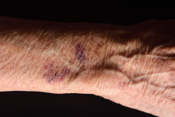 close up of a bruise in the arm of senior woman
