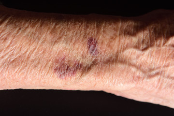 close up of a bruise in the arm of senior woman