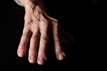 finger with rheumatism senior woman