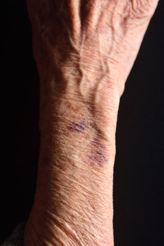 Close Up Of A Bruise In The Arm Of Senior Woman