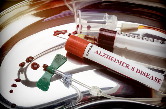 blood sample to investigate remedy against Alzheimer's disease, conceptual image
