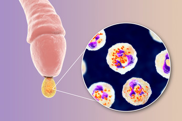 Male gonorrhea, medical concept. 3D illustration showing close-up view of Neisseria gonorrhoeae bacteria inside neutrophils with incomplete phagocytosis found in smear from man urethra
