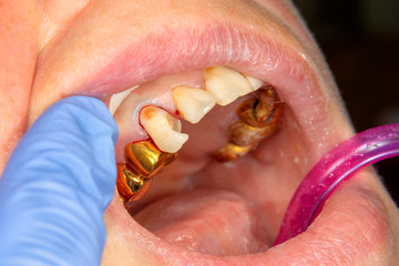 Dental caries. Filling with dental composite photopolymer material using rabbders. The concept of...